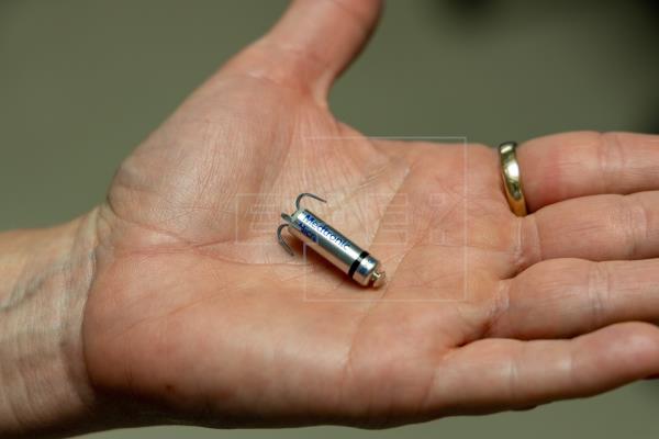Le plus petit stimulateur cardiaque au monde implanté avec succès au CHR